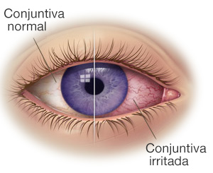 conjuntivitis-barcelona