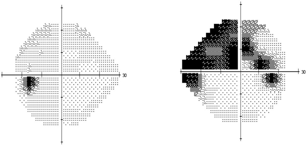 examen-visual-glaucoma