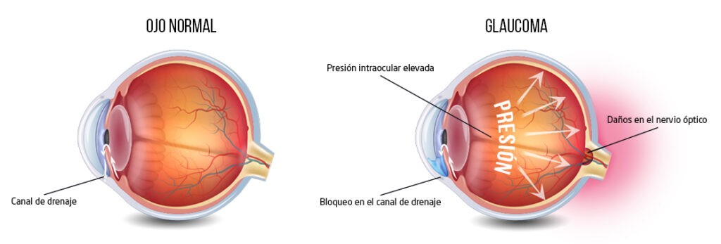 glaucoma-barcelona