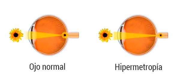 hipermetropia-barcelona