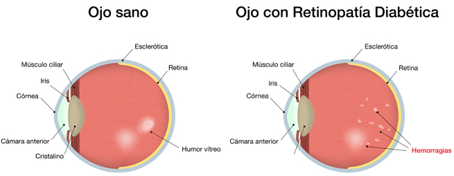retinopatia-diabetica-barcelona