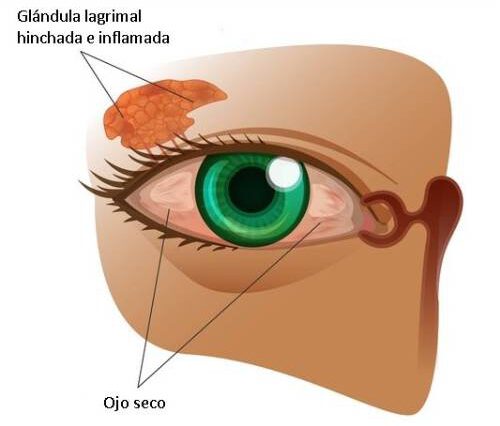 sindrome-del-ojo-seco-barcelona